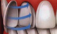dental veneers 